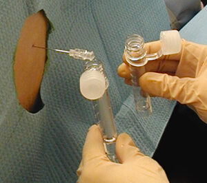 Lumbar Puncture Trays w / Titan™ Quincke Spinal Needles