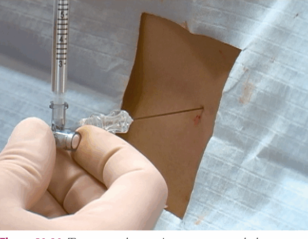 Lumbar Puncture Trays w / Titan™ Quincke Spinal Needles