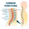 Lumbar Puncture Trays w / Titan™ Quincke Spinal Needles