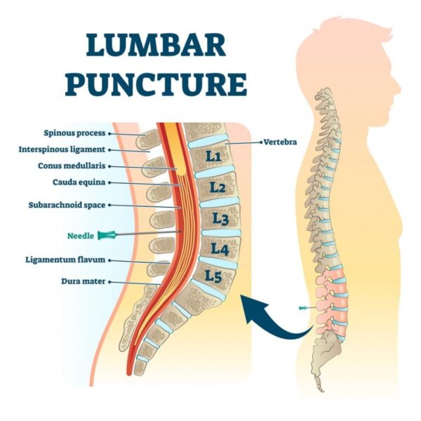 Lumbar Puncture Trays w / Titan™ Quincke Spinal Needles
