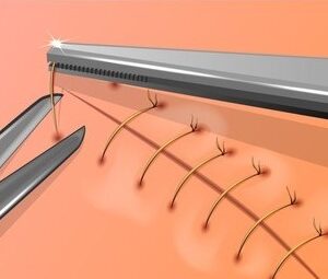 Suture Removal Kits