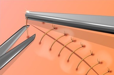 Suture Removal Kits